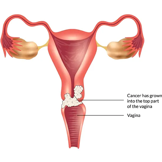 Vaginal Cancer - Symptoms, Types, Causes & Diagnosis